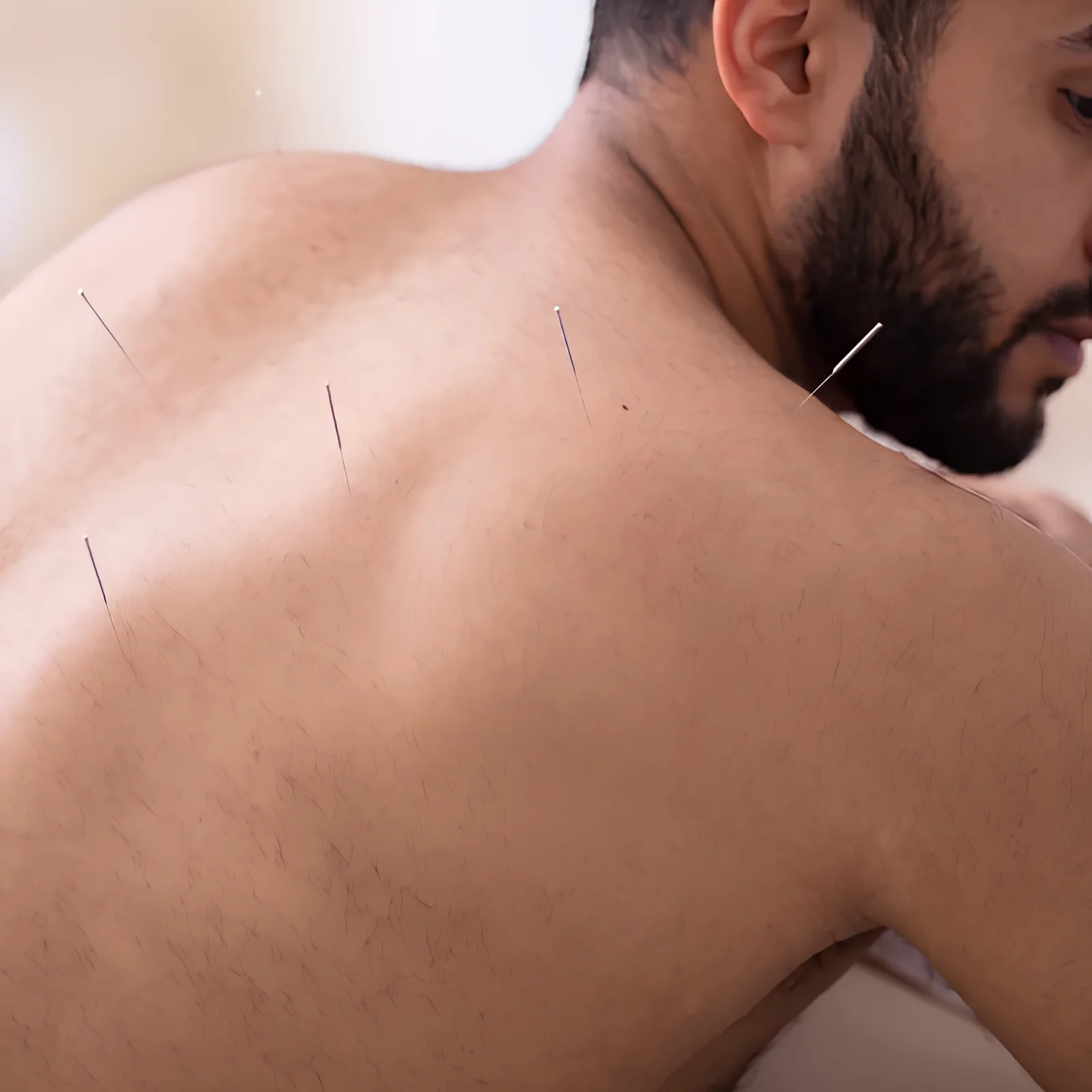 Dry needling therapy