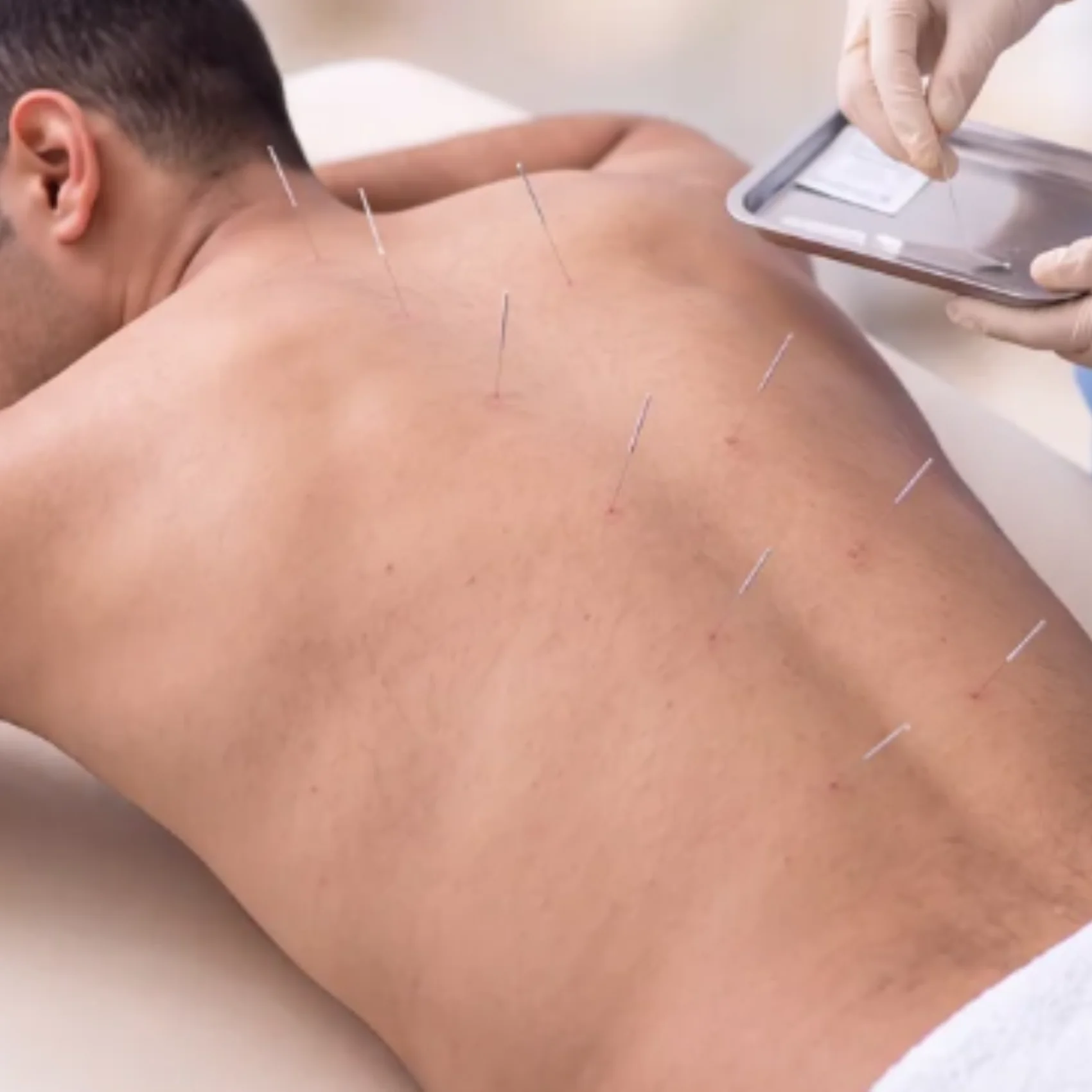 Dry Needling