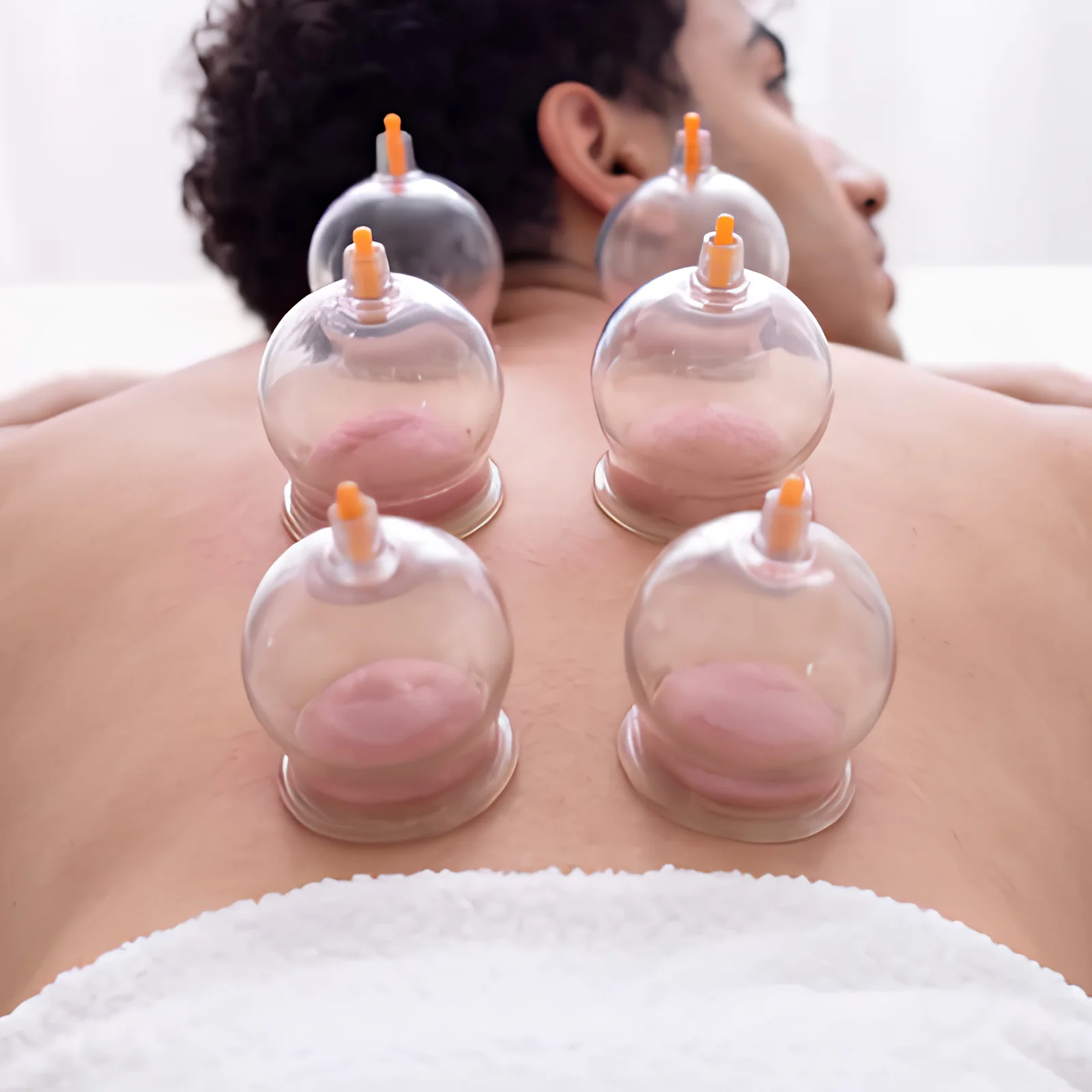 Cupping therapy