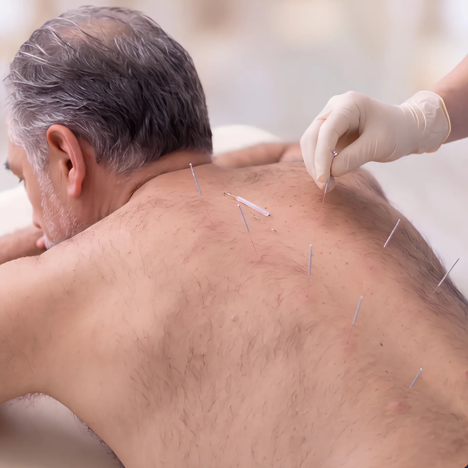 Dry needling therapy