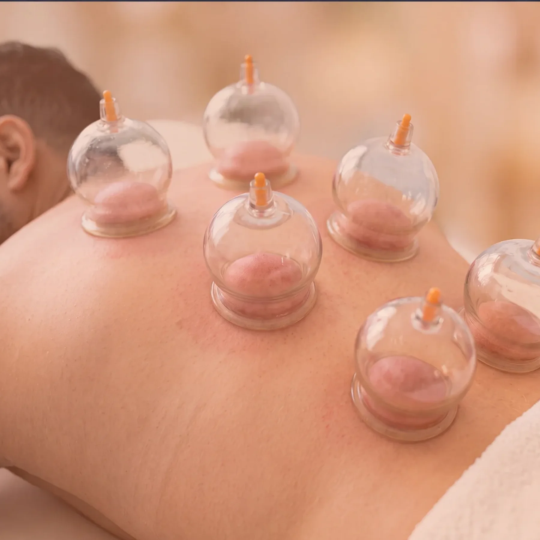 Dry Cupping